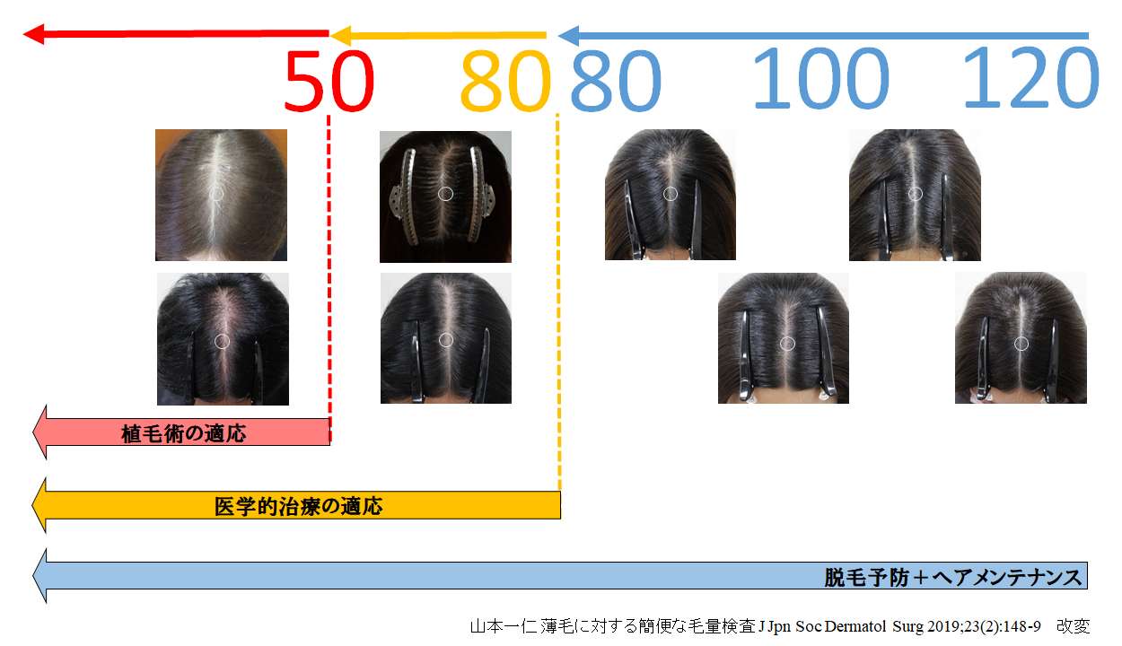 毛量の見方と治療法