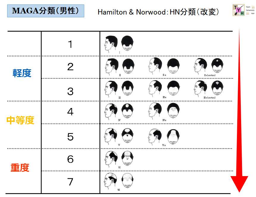 AGAの進行とHN分類