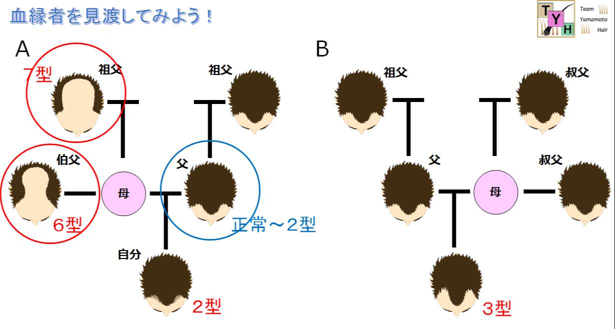 遺伝的要因とAGAの推測
