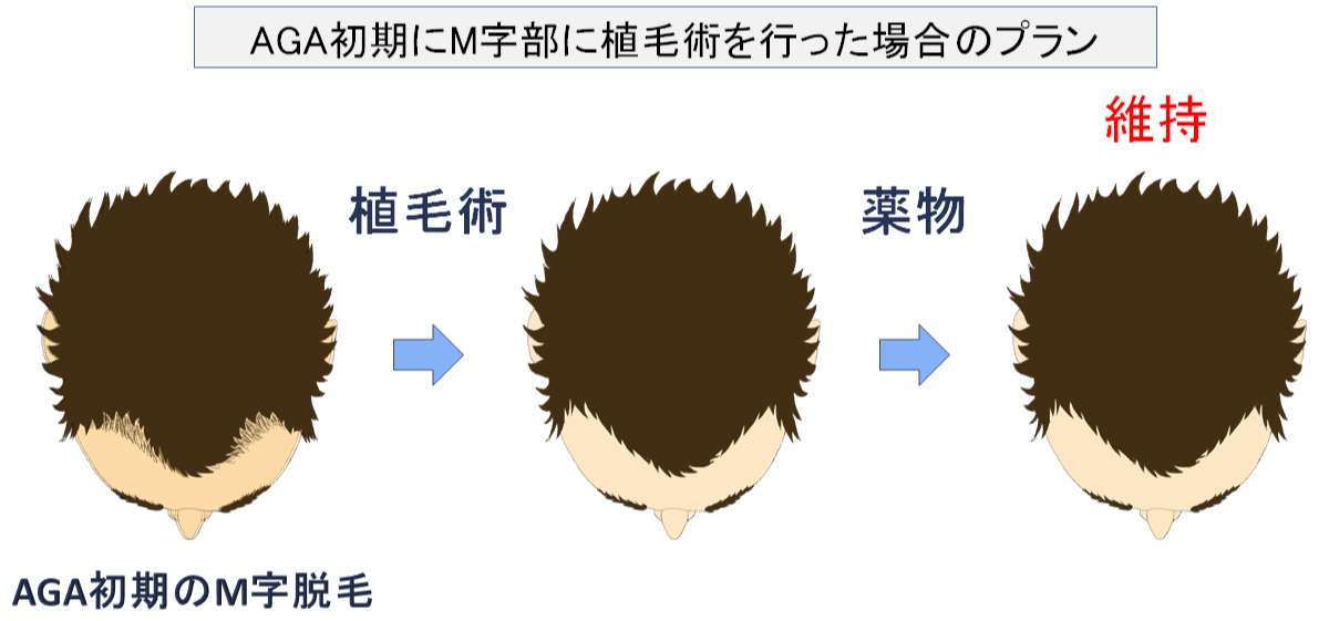 M字脱毛の進行と治療