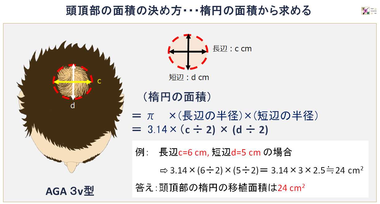 移植密度の選択