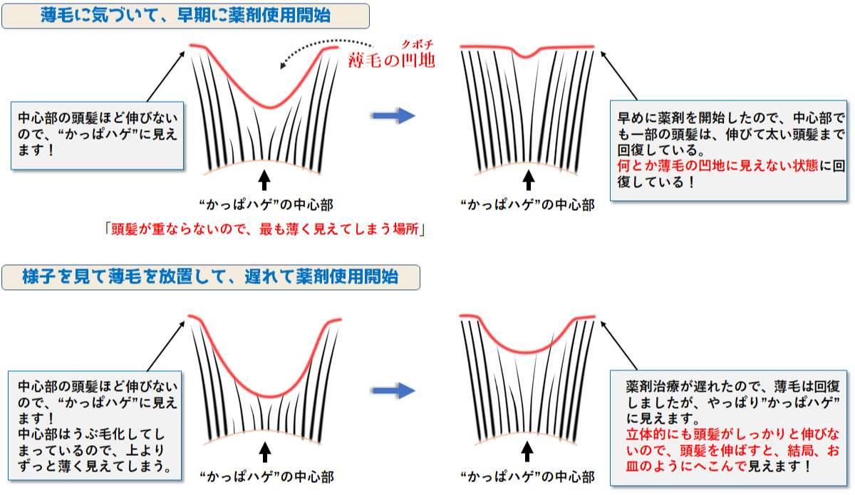 かっぱハゲの治療原理