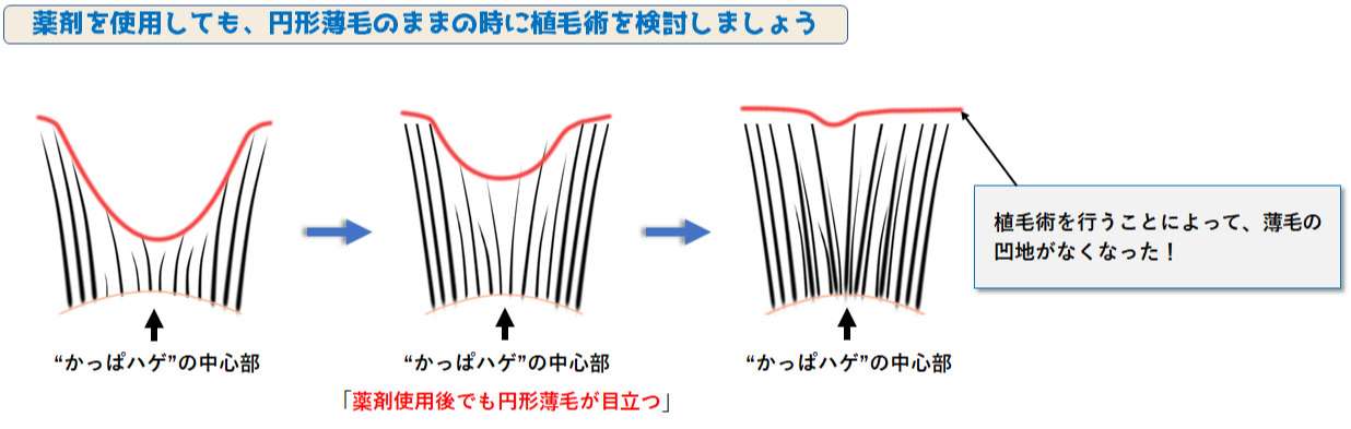 かっぱハゲの植毛術