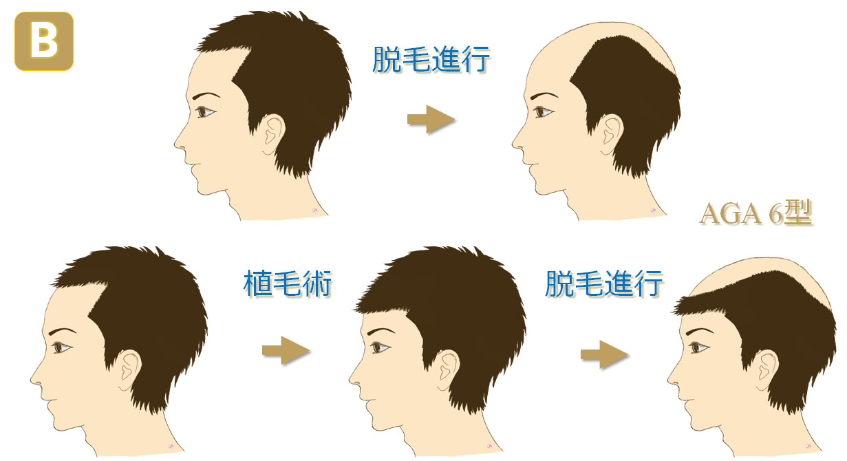 生え際を下げた場合の問題