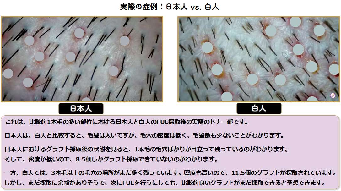 日本人と白人のドナー比較