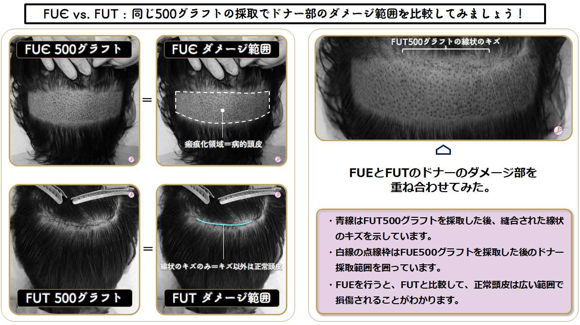 FUE vs. FUT donor area