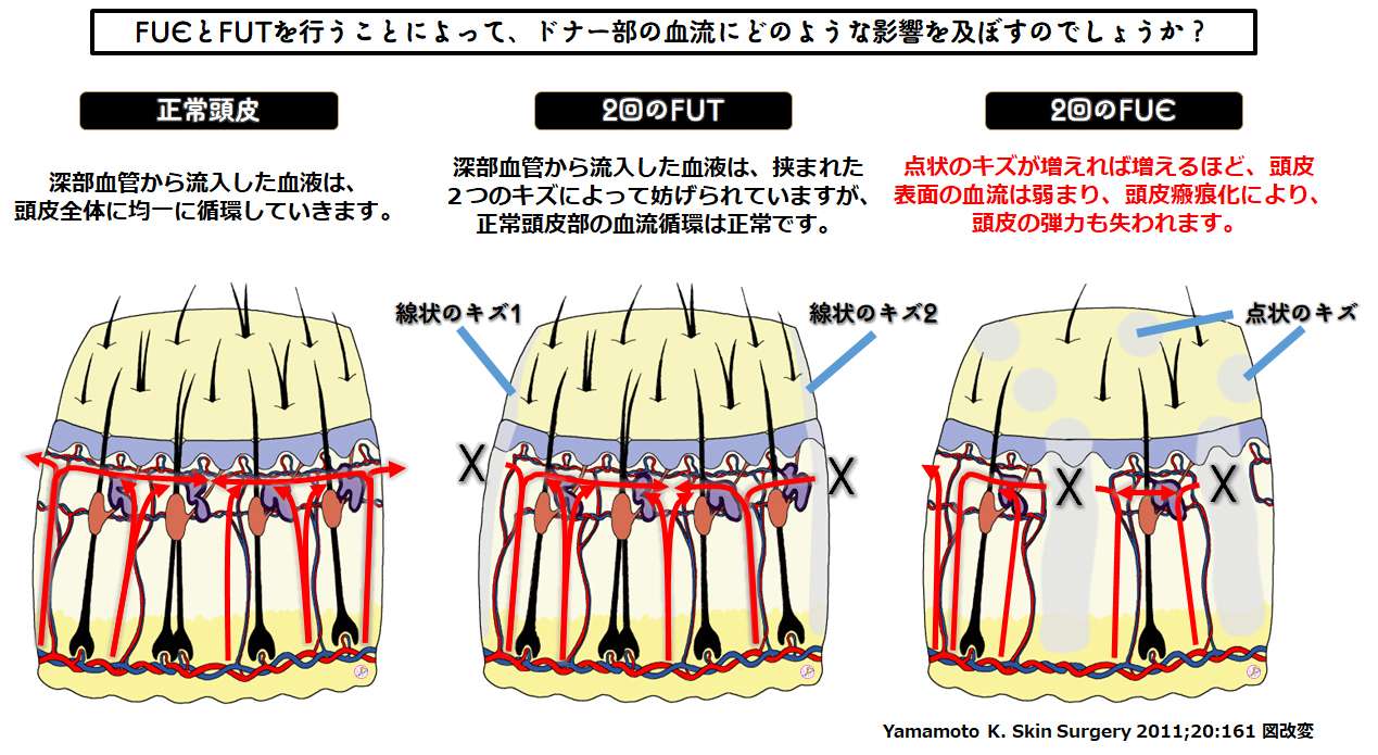 FUE vs. FUT blood supply