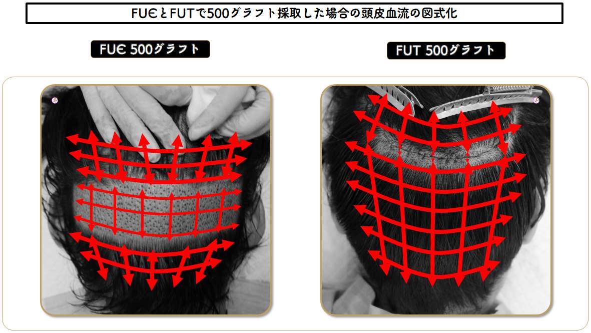 FUE vs. FUT blood supply_figure