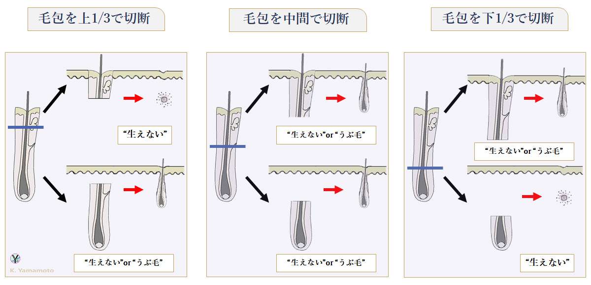 切断毛の生存率の問題
