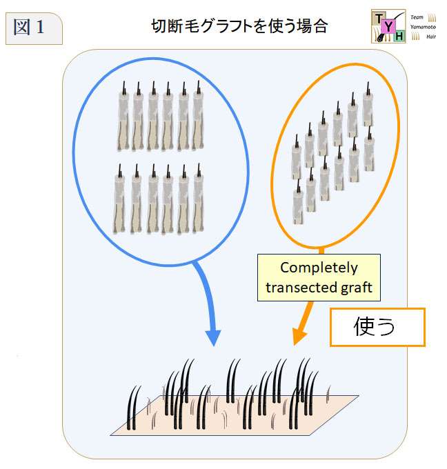 Completely transected graft を移植した場合