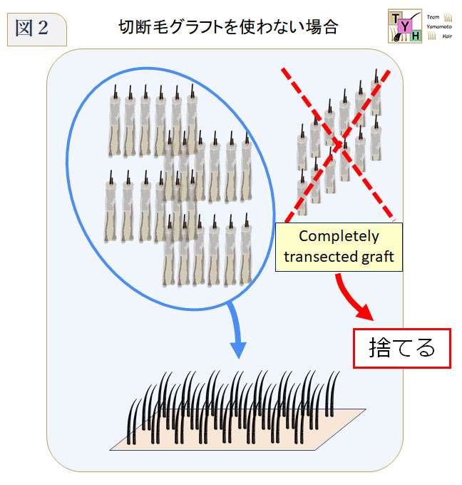 Completely transected graft を捨てた場合