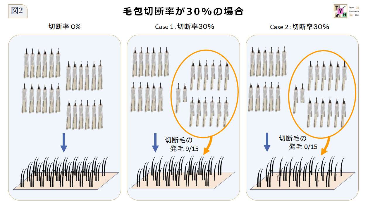 毛包切断率30%のケース