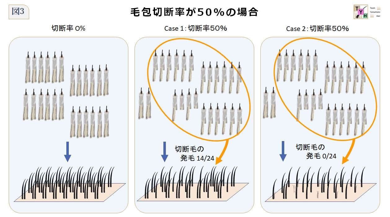 毛包切断率50%のケース