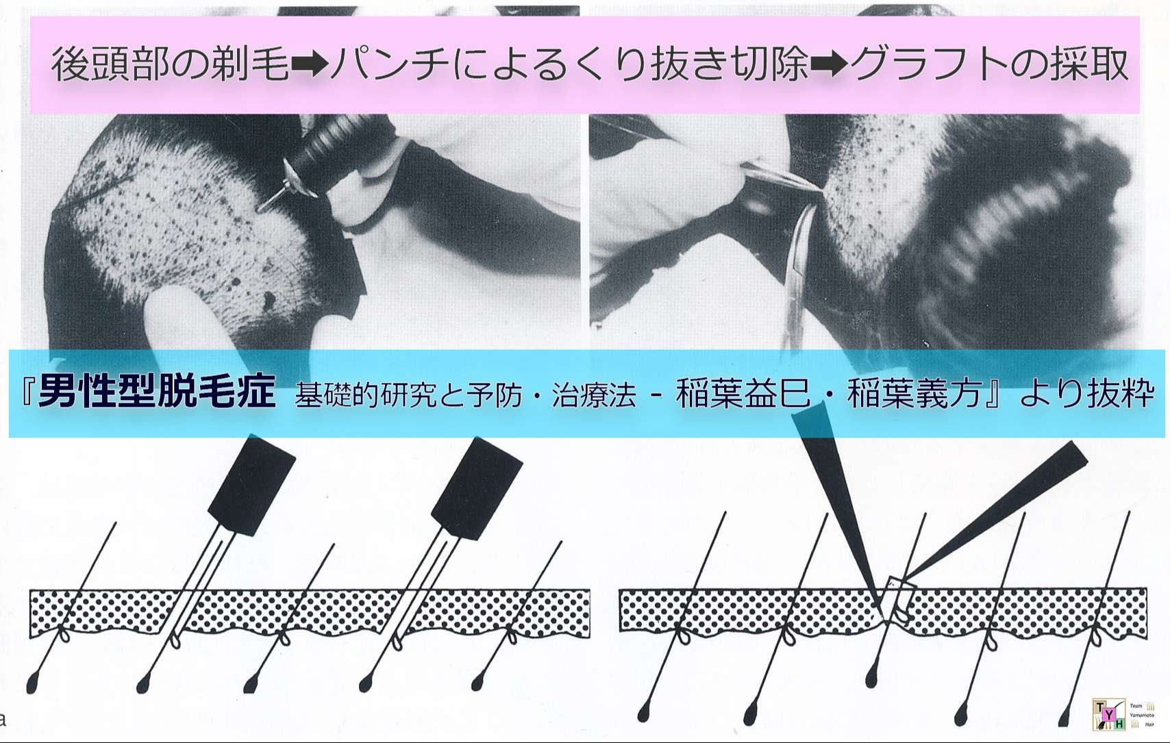 稲葉益巳医師のFUE技術