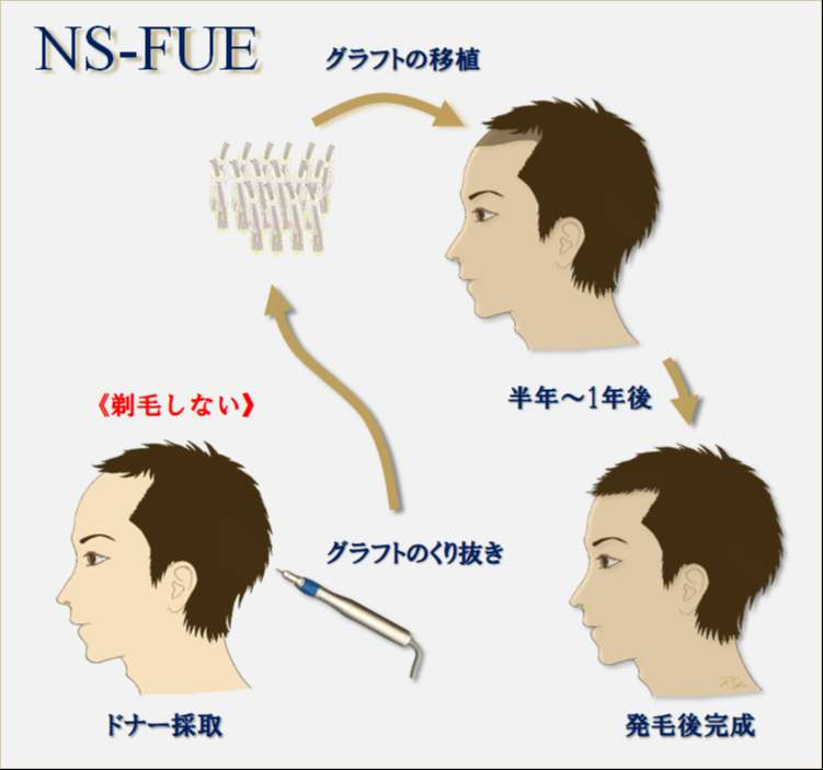 NS-FUE