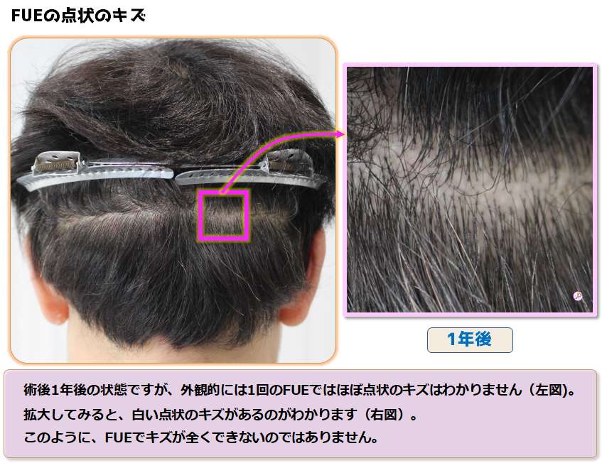 FUEで後頭部を剃毛した場合